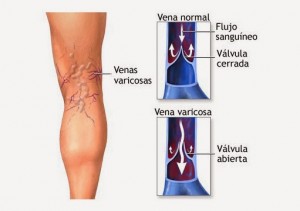varices 2